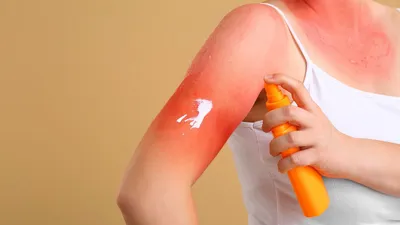 Аллергия на солнце у ребенка. Фотодерматит (фотодерматоз). Наш опыт -  YouTube