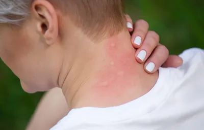 Аллергия на солнце: что нужно знать. Графика | Видео | Известия | 31.03.2023
