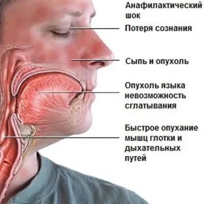 Анафилактический шок: причины, симптомы, лечение - YouTube