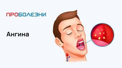 Ангина - лечение и симптомы, диагностика ангины в Москве, Клинический  Госпиталь на Яузе