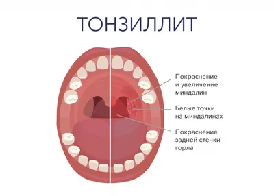 Тонзиллит острый (старое название - Ангина) - добрый доктор