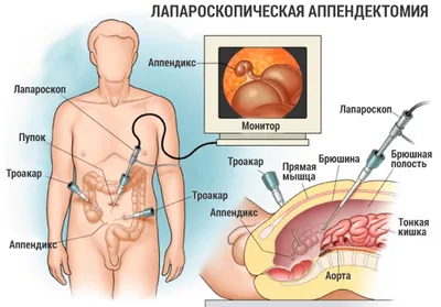 Аппендэктомия