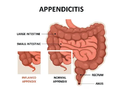 Аппендицит: с какой стороны, симптомы, причины возникновения, лечение