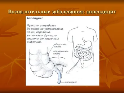 Аппендэктомия: удаление аппендицита в Киеве ᐉ ADONIS | Киев