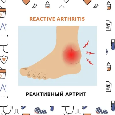 Реактивный артрит/Reactive arthritis