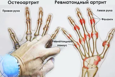 Лечение ревматоидного артрита в ЦБС - избавляем от боли! Препараты  Голимумаб, Инфликсимаб, Ритуксимаб