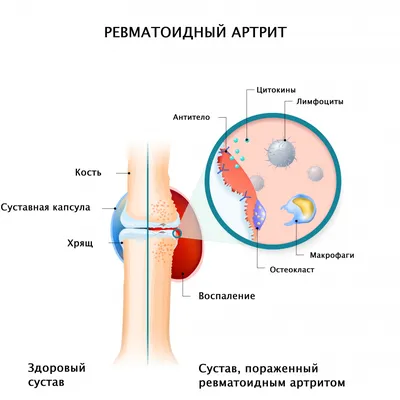 Ревматоидный артрит: симптомы, диагностика, лечение