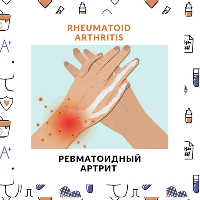 Артрит. Уникальная методика лечение артрита без медикаментов в Киеве