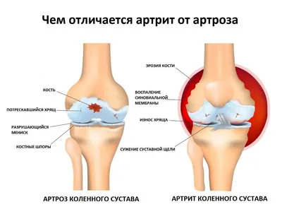 Артрит пальцев рук: причины, симптомы и лечение