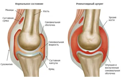Артрит и заболевания суставов - ранние симптомы, типы болезни и лечение |  РБК Украина