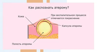 Атерома - причины появления, симптомы заболевания, диагностика и способы  лечения