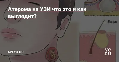 Vita Alliance - Что такое атерома? 🧐 Атерома – это киста подкожной сальной  железы, безболезненная, не представляющая опасности для жизни и здоровья  (несмотря на устрашающий вид!), но создающая косметический дефект. Народное  название – «