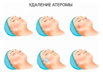 Атерома: фото, на голове, за ухом, на спине, лечение, удаление