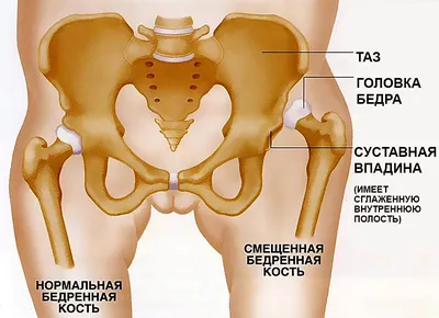 Разрыв сухожилия четырехглавой мышцы бедра | Zabigorekk | Дзен