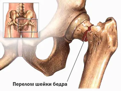 Щелкающее бедро — Травмаорто