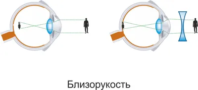 Близорукость - офтальмологическая клиника \"Визус\" в Пскове