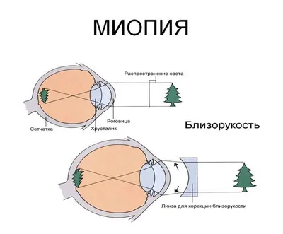 Лечение близорукости в Санкт-Петербурге - Клиника ЮВТ