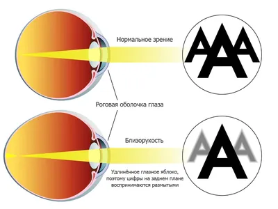 Лечение близорукости. Компания АртОптика г. Челябинск