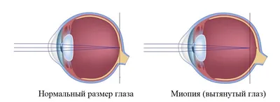 Осложненная миопия: почему нельзя игнорировать близорукость