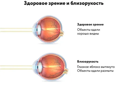 Лечение близорукости у детей и подростков в Железнодорожном | «Доктор  Глазов»