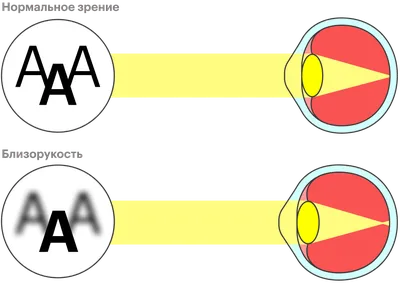 Близорукость - \"Ива-меди\"