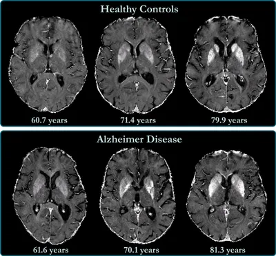 Болезнь Альцгеймера. Психосоматика | ПСИХОЛОГИЯ без бла-бла-логии | Дзен