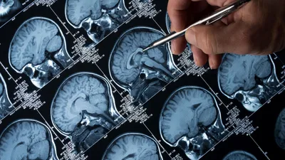 Симптомы болезни Альцгеймера - как обнаружить болезнь раньше времени,  открытие ученых | РБК Украина