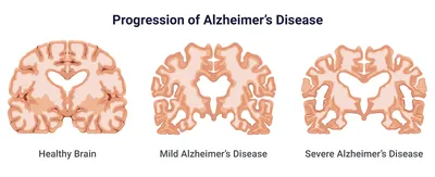 Деменция и болезнь Альцгеймера, Heike Bonin – скачать книгу fb2, epub, pdf  на ЛитРес