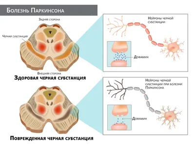 Болезнь Паркинсона ✓: симптомы, признаки и причины, диагностика и лечение