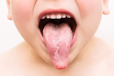 Глоссит — воспаление языка Причины, Лечение, Профилактика