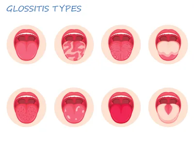 Глоссит. Болезнь языка