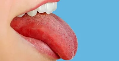 Определение болезни языком. Открытый рот и язык торчащими. Изменения в  болезнях и появления у. Изображение вектора Иллюстрация вектора -  иллюстрации насчитывающей насмешливый, изменения: 190024477