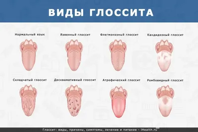 Географический язык - причины, этиология, виды, симптомы, диагностика,  лечение