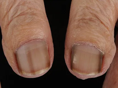 New Stage Центр Подологии, Маникюра и Педикюра - Не грибковые болезни ногтей:  1️⃣ Микронихия — это уменьшение площади ногтевой пластины. Чаще всего  проявляется как короткие ногти. Иногда изменения затрагивают не только  размер,