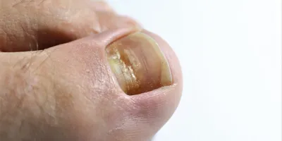 Пин от пользователя Lis на доске болезни ногтей и кожи | Ногти