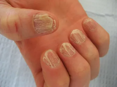 Онихомикоз (грибок ногтей): причины, симптомы и лечение в статье клиники  «СОВА»
