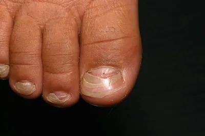 12 самых частых заболеваний ногтей: что знать мастеру маникюра
