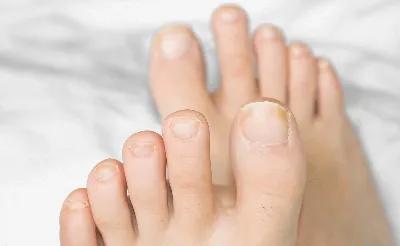 Причины утолщения ногтей и как лечить патологию