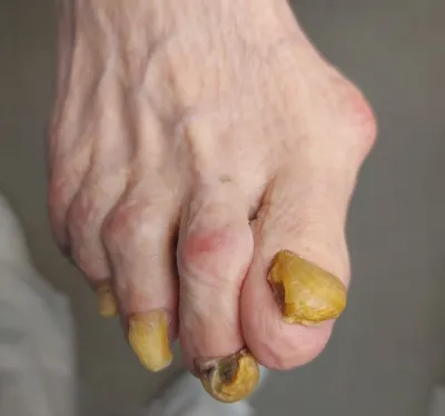 Грибок ногтей на ногах