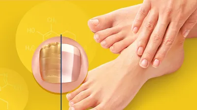 Грибковые заболевания на ногтях: признаки, причины и как их лечить?