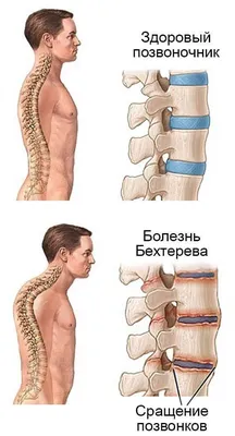 Болезнь Паркинсона: лечение заболевания, подходы и методы борьбы в России |  Как помочь больному паркинсонизмом