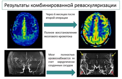 Болезнь Бехтерева - причины появления, симптомы заболевания, диагностика и  способы лечения