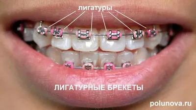Виды брекетов в ортодонтии