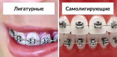 Керамические брекеты цена в Красноярске - СмайлДент - центр имплантации и  стоматологии