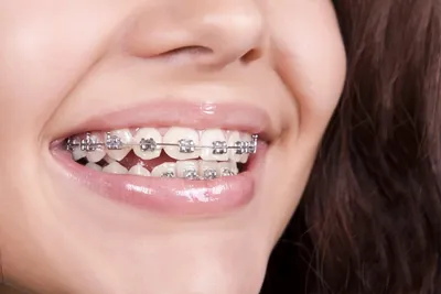 Брекет-система - шаг к красивой улыбке - интересно об ортодонтии,  имплантации и протезировании зубов