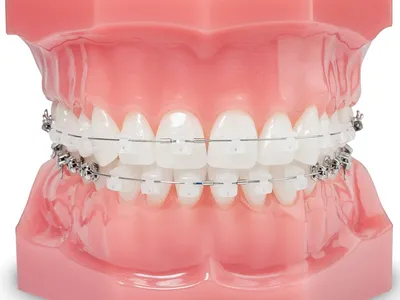 Сколько нужно носить брекеты – стоматология ПрезиДЕНТ