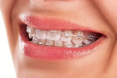 Брекеты на верхнюю челюсть в Омске, цены на установку в стоматологии  «Ортодонт-центр»
