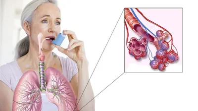 11 декабря - Всемирный день больного бронхиальной астмой - ГБУЗ ЯНАО