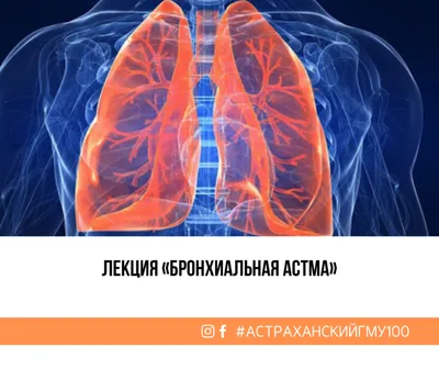 Как проявлется приступ бронхиальной астмы