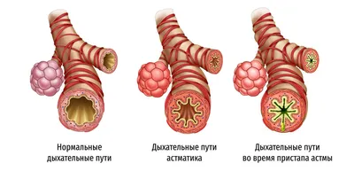 бронхиальная астма | Аллергология и Иммунология